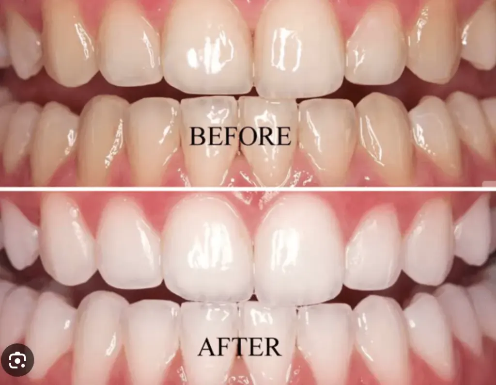 Teeth Whitening at best dental clinic in BTM layout, Bangalore
