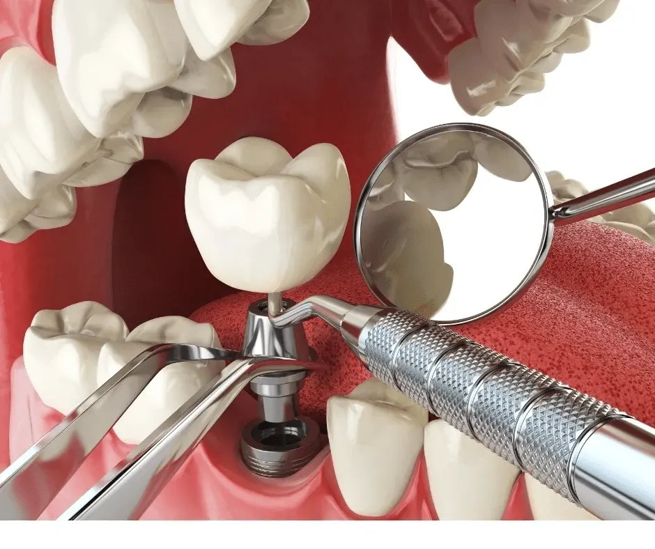 Dental Implants at best dental clinic in BTM layout, Bangalore