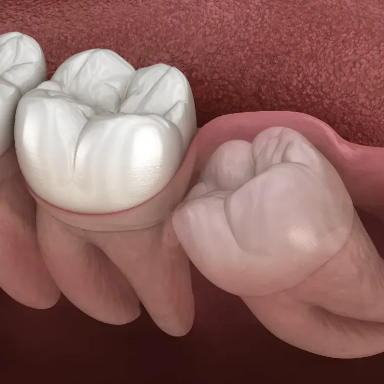 Wisdom Teeth Removal Duration