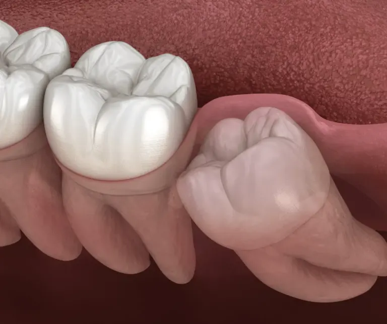 Wisdom Teeth Removal Duration