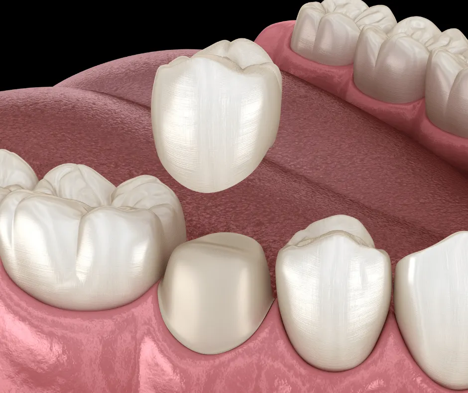 Ceramic crowns (PFM Crowns) for natural looking teeth at best dental clinic in BTM layout, Bangalore