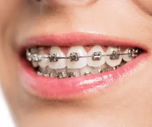 Metal braces at best dental clinic in BTM layout, Bangalore