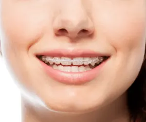 Ceramic braces BTM Layout
