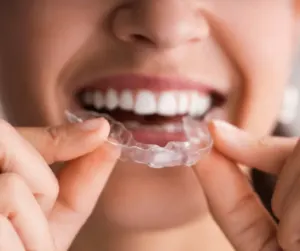 clear braces/ Invisaligners at best dental clinic in BTM layout, Bangalore