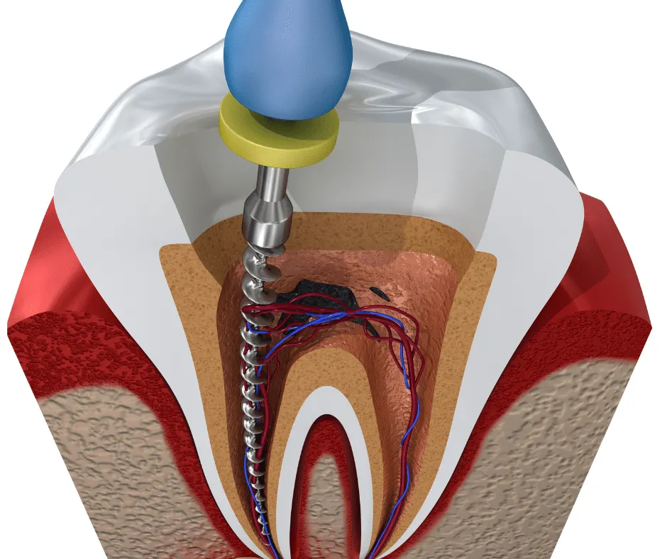 Root canal Treatment (RCT) at best dental clinic in BTM layout, Bangalore
