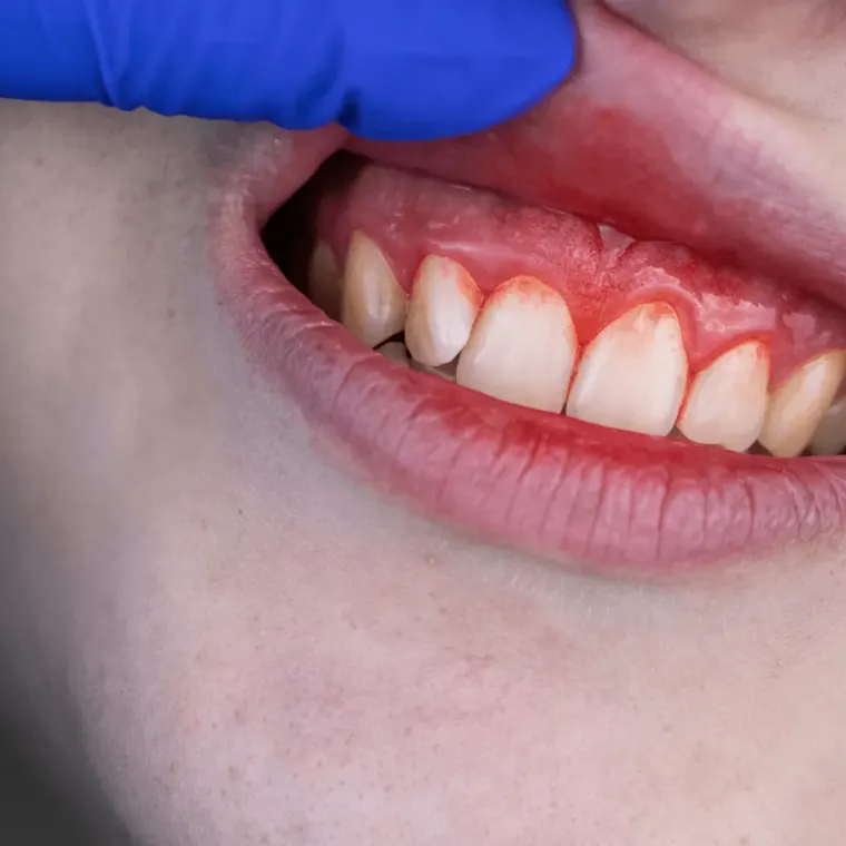 Bleeding gums — Dentick Dental Care, Bengaluru