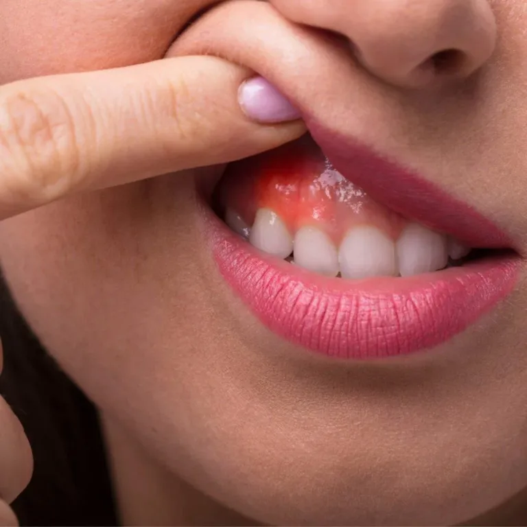 Gum desease 000 — Dentick Dental Care, Bengaluru