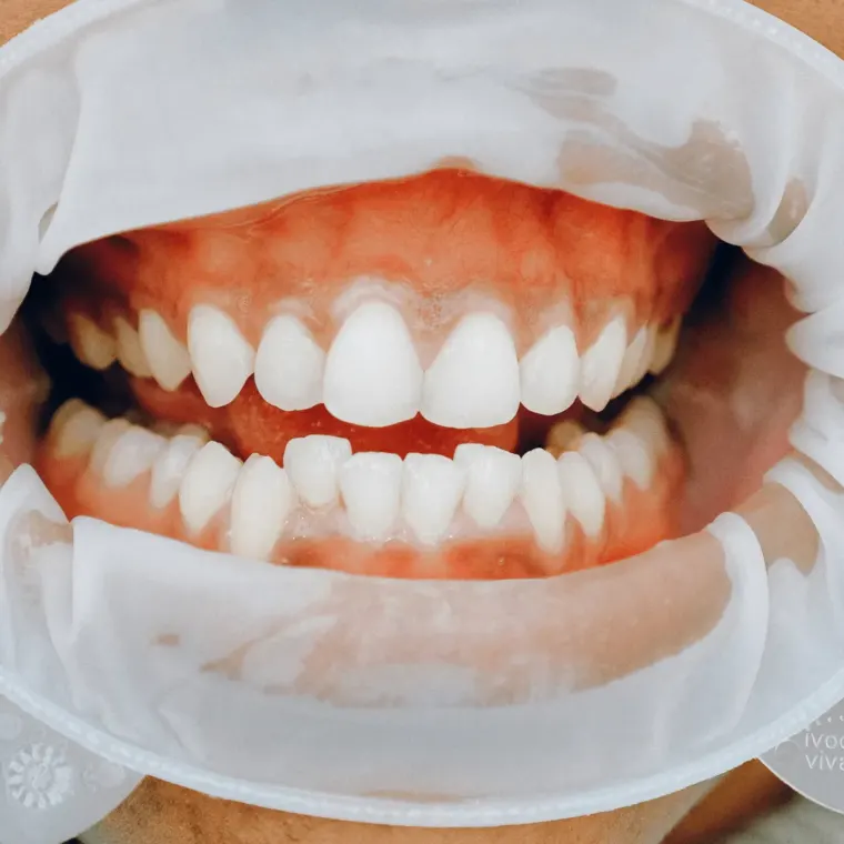 Receding gums — Dentick Dental Care, Bengaluru