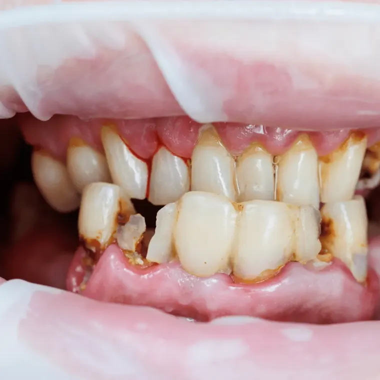 Swollen gums — Dentick Dental Care, Bengaluru