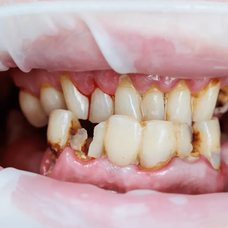Swollen gums — Dentick Dental Care, Bengaluru