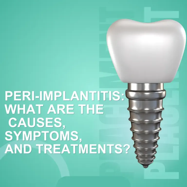 Peri-Implantitis Causes, Symptoms, Treatments