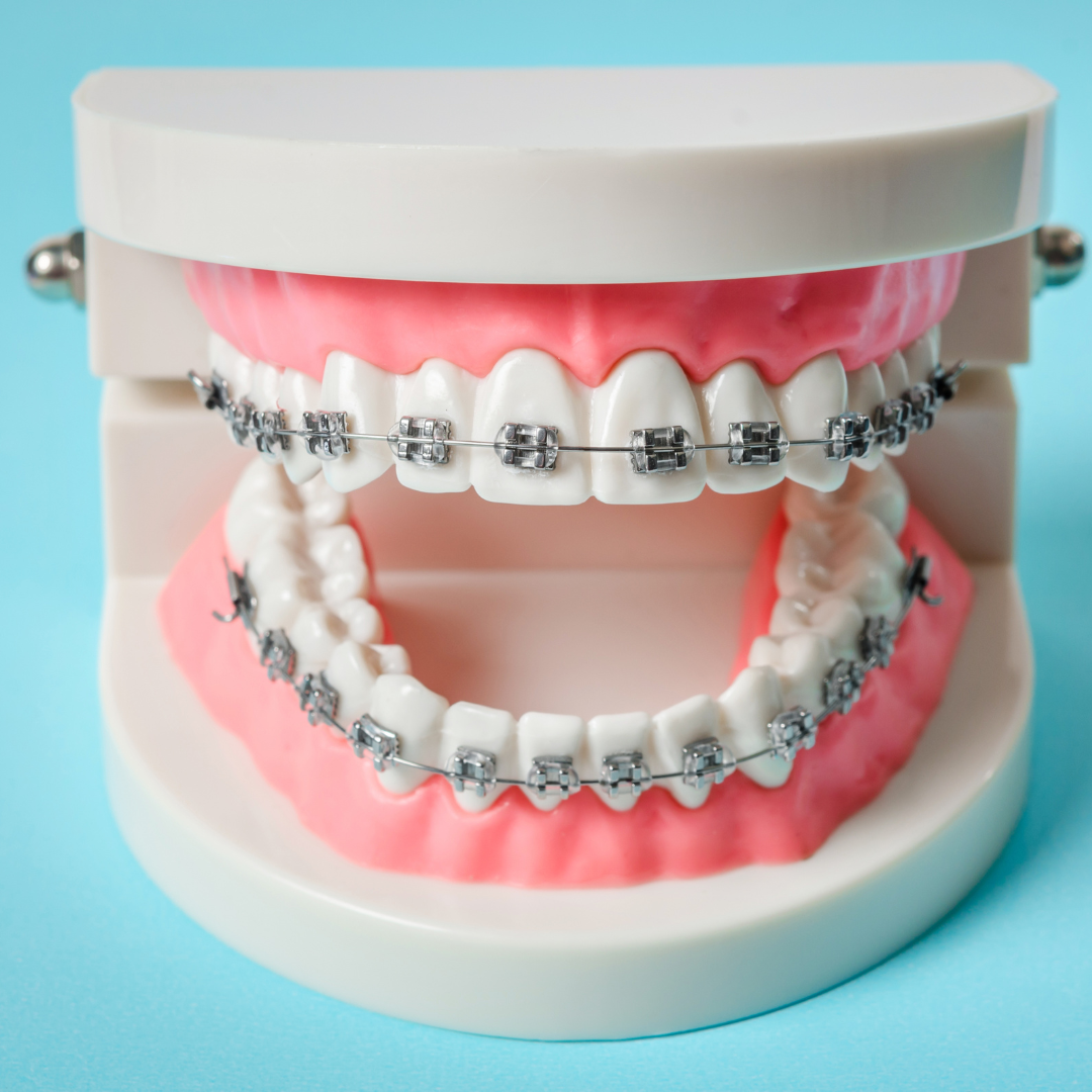 Can You Straighten Teeth Naturally? What Works | Dentick