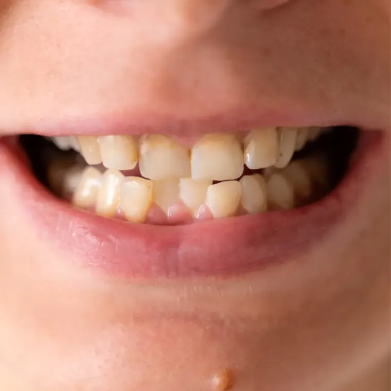 crossbites