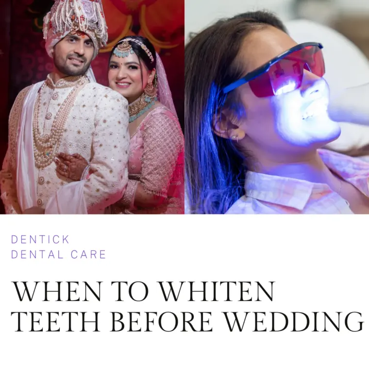 WHEN TO WHITEN TEETH BEFORE WEDDING