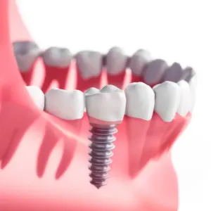 Dental implant demonstrating precise placement of the implant post.