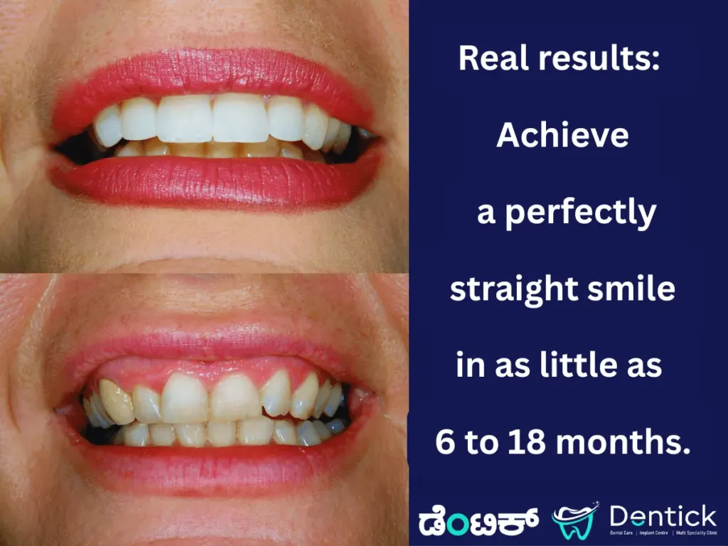 Before and after comparison photos of a patient's smile showing straight teeth after clear aligner treatment.