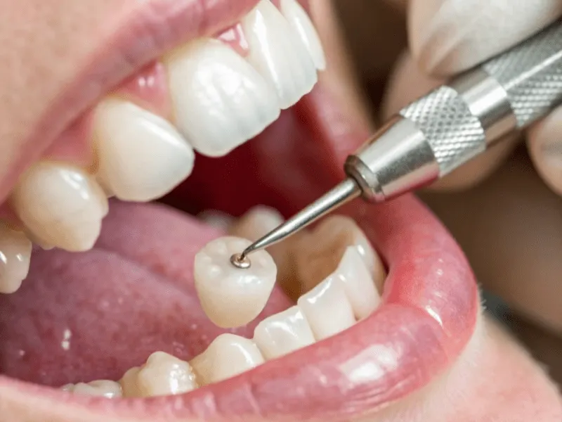 Dental crown used to restore a tooth after root canal treatment.