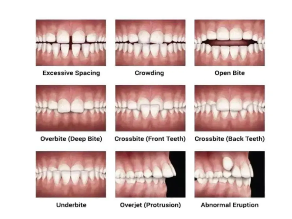 Dental infographic showing teeth conditions treated by aligners: gapped teeth, overbite, underbite, crowded teeth, and crossbite.