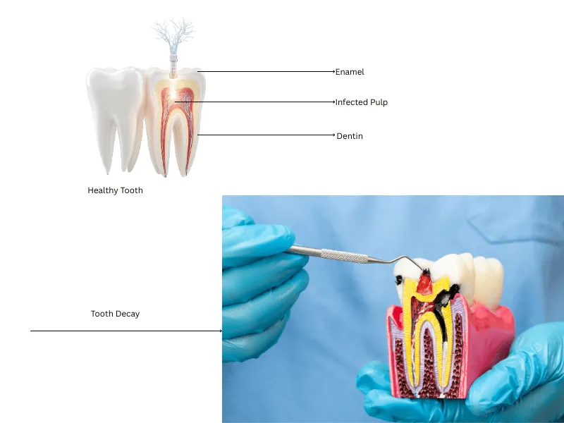 Diagram showing tooth anatomy and infected pulp requiring root canal therapy.