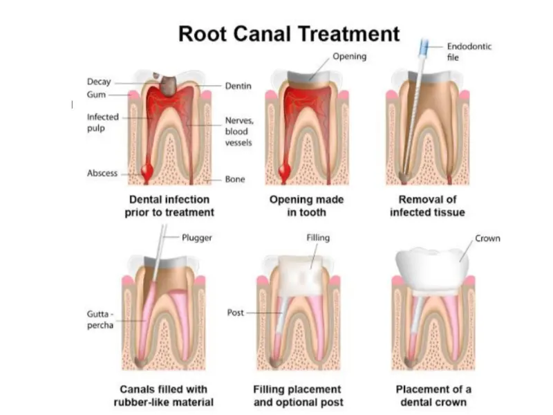 Steps of a modern root canal procedure: cleaning, filling, and sealing.