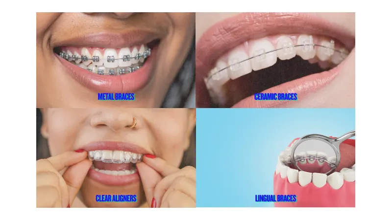 Types of dental braces Comparison graphic showing four different types of dental braces: metal, ceramic, lingual, and clear aligners.