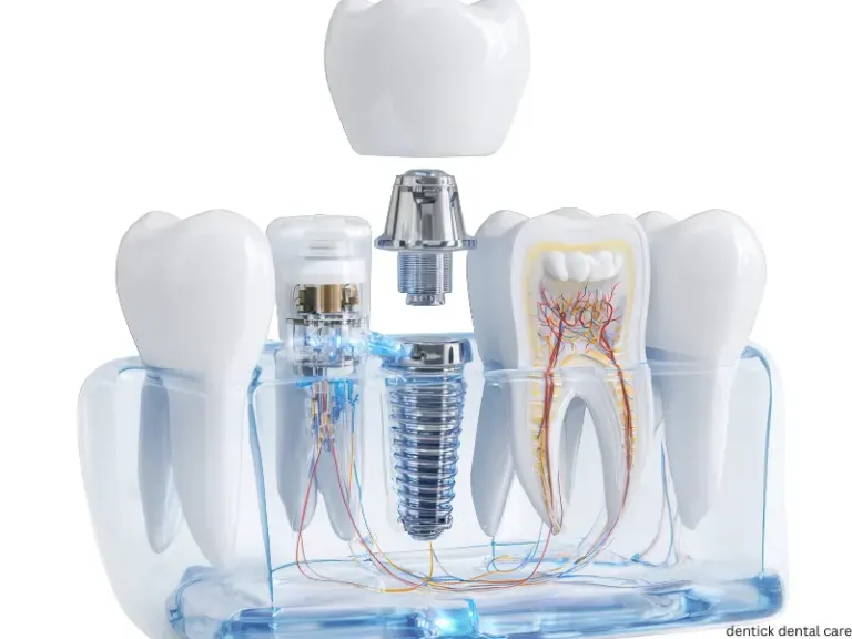 Cross-section of a dental implant showing the titanium screw, abutment, and porcelain crown.