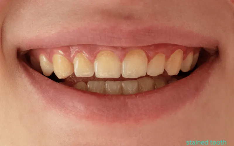 Causes of tooth discoloration and enamel thinning explained by Dentick Dental Care.