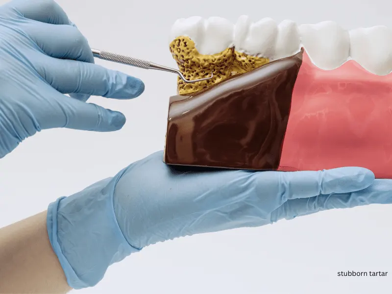 Difference between dental scaling and teeth polishing procedures.