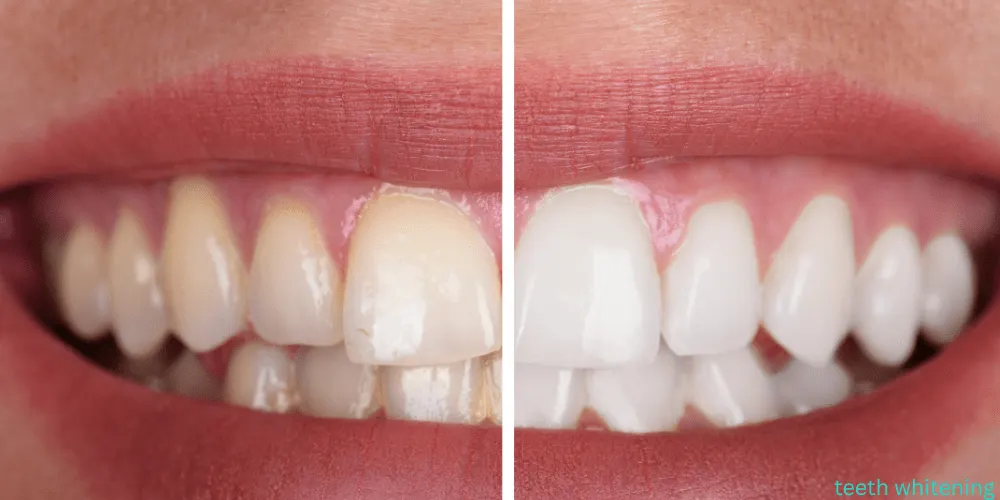 Teeth whitening before and after results showing 8 shades whiter smile.