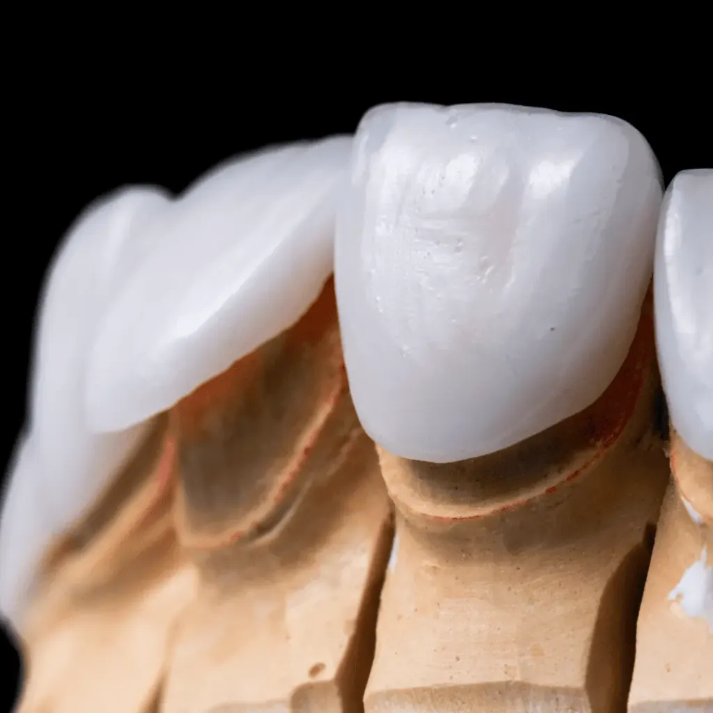 Ceramic veneers per tooth — Dentick Dental Care, Bengaluru