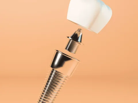 CBCT-guided dental implant treatment at Dentick Dental Care, Bengaluru