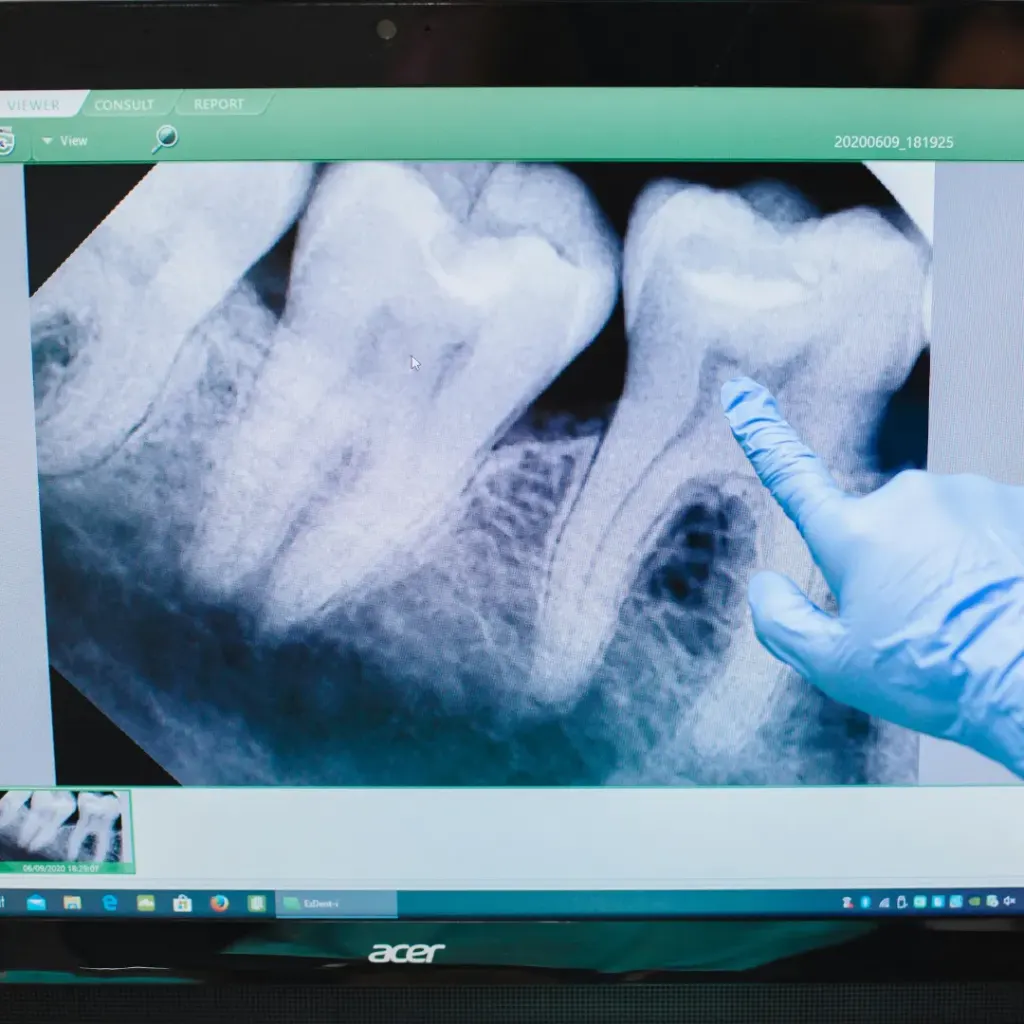 Dental x ray IOPA — Dentick Dental Care, Bengaluru
