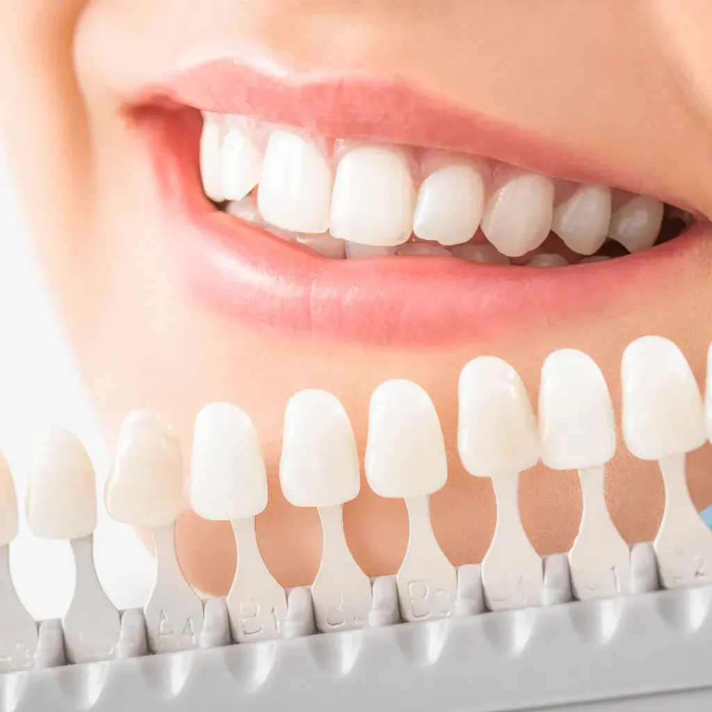 In-clinic professional teeth whitening at Dentick Dental Care, Bengaluru