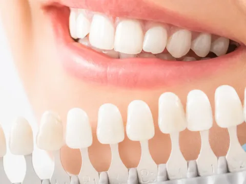 In-clinic professional teeth whitening at Dentick Dental Care, Bengaluru