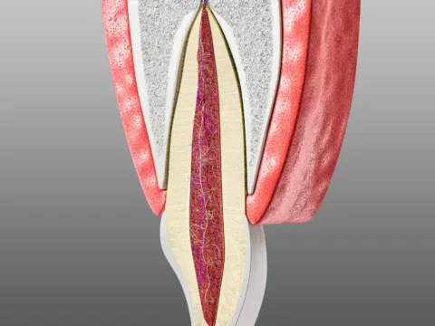 Root canal treatment on a front tooth at Dentick Dental Care, Bengaluru