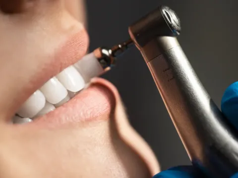 Teeth scaling and polishing treatment at Dentick Dental Care, Bengaluru