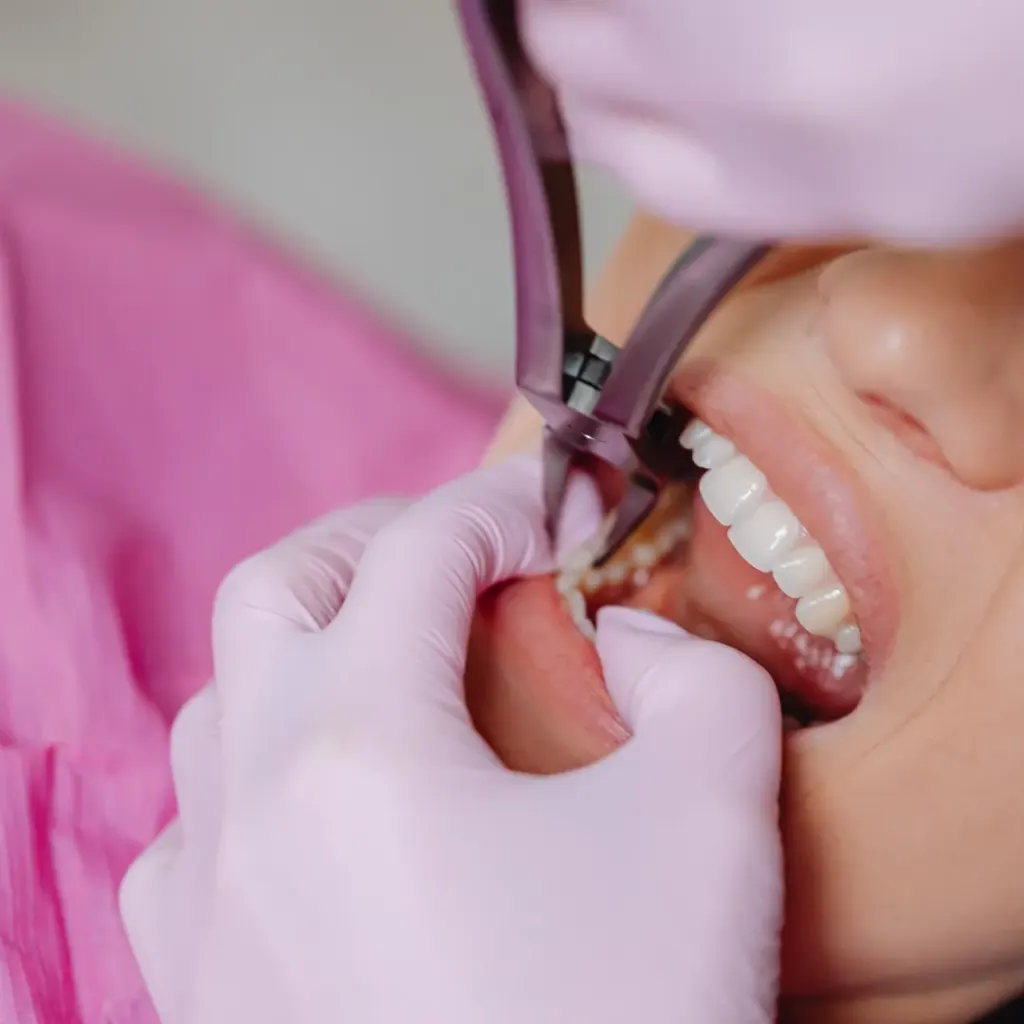 Tooth extraction simple — Dentick Dental Care, Bengaluru
